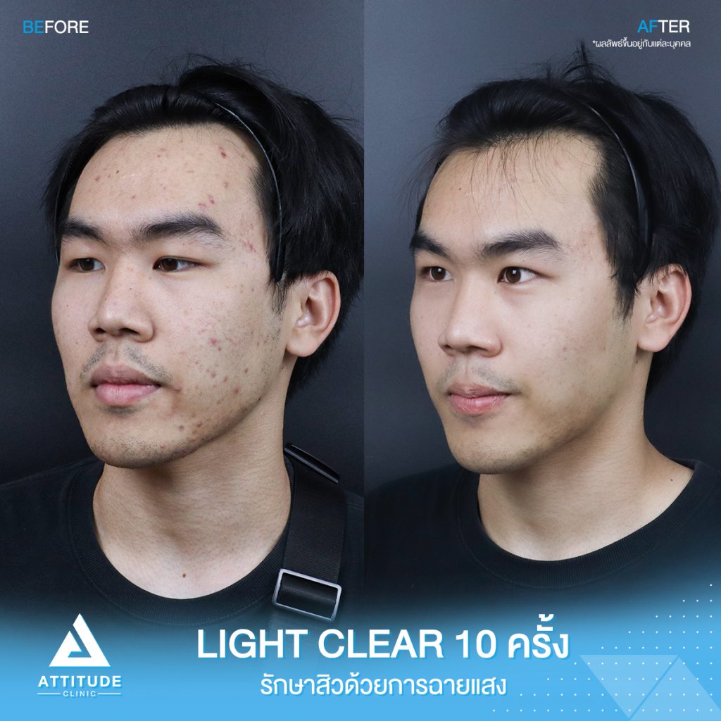 สิวเยอะแค่ไหนก็ไม่กลัว! รีวิวรักษาสิวด้วยการฉายแสงโปรแกรม Light Clear 7 ขั้นตอน จำนวน 10 ครั้ง ของน้องพอล มีปัญหาสิวและรอยสิวจัดเต็ม