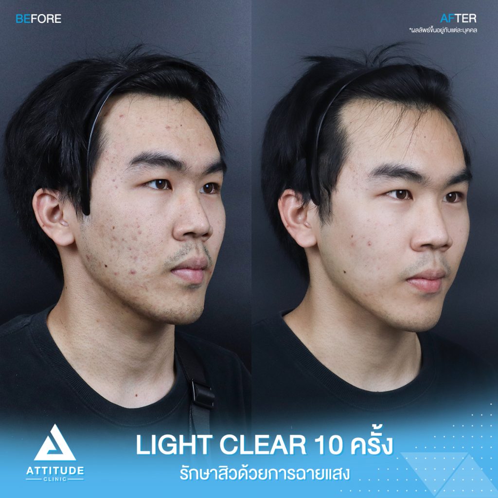 สิวเยอะแค่ไหนก็ไม่กลัว! รีวิวรักษาสิวด้วยการฉายแสงโปรแกรม Light Clear 7 ขั้นตอน จำนวน 10 ครั้ง ของน้องพอล มีปัญหาสิวและรอยสิวจัดเต็ม