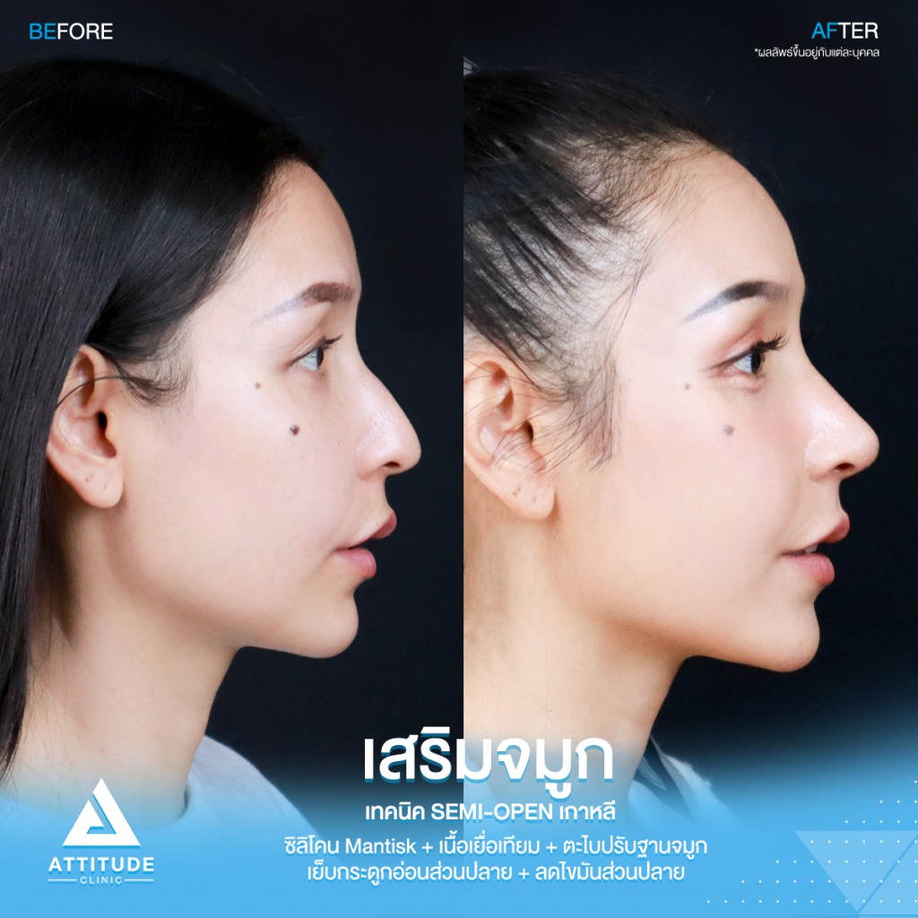 รีวิวเสริมจมูกคุณเฟียทส์ รีวิวเสริมจมูกคุณเฟียทส์ ด้วยซิลิโคน Mantisk เฉพาะปลายจมูก เคสจมูกมีฮัมพ์ ปลายงุ้ม ปรับโครงสร้างก่อนวางซิลิโคน เทคนิค Semi Open เกาหลี เน้นความเป็นธรรมชาติ โดยคุณหมอยุ้ย