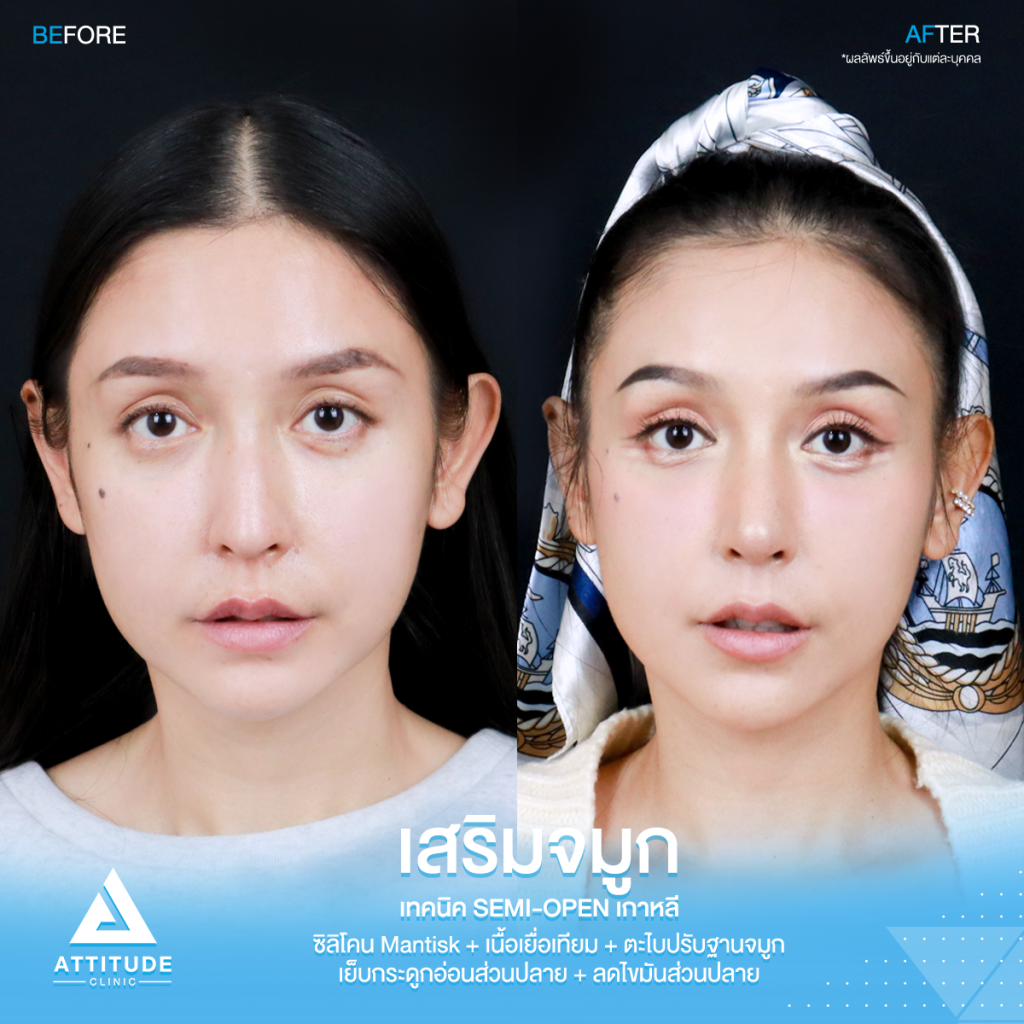 รีวิวเสริมจมูกคุณเฟียทส์ รีวิวเสริมจมูกคุณเฟียทส์ ด้วยซิลิโคน Mantisk เฉพาะปลายจมูก เคสจมูกมีฮัมพ์ ปลายงุ้ม ปรับโครงสร้างก่อนวางซิลิโคน เทคนิค Semi Open เกาหลี เน้นความเป็นธรรมชาติ โดยคุณหมอยุ้ย