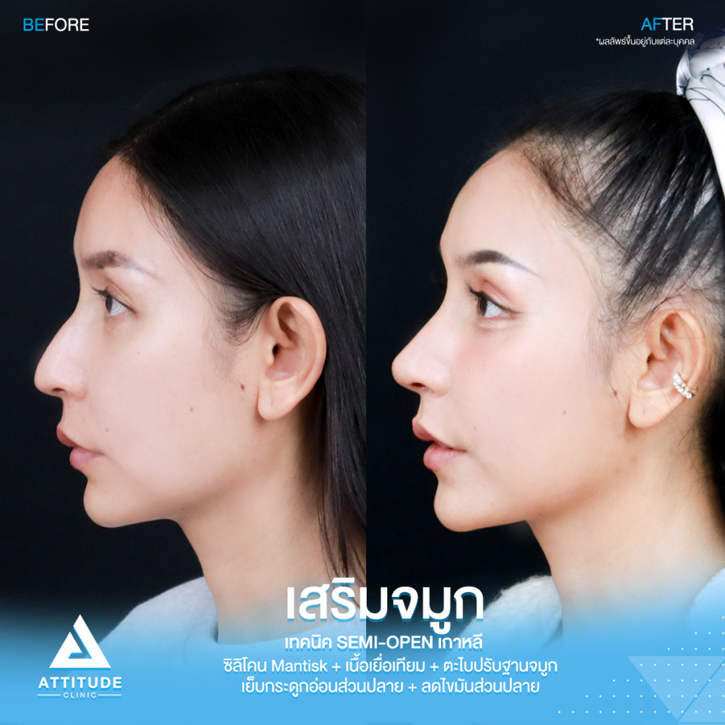 รีวิวเสริมจมูกคุณเฟียทส์ รีวิวเสริมจมูกคุณเฟียทส์ ด้วยซิลิโคน Mantisk เฉพาะปลายจมูก เคสจมูกมีฮัมพ์ ปลายงุ้ม ปรับโครงสร้างก่อนวางซิลิโคน เทคนิค Semi Open เกาหลี เน้นความเป็นธรรมชาติ โดยคุณหมอยุ้ย