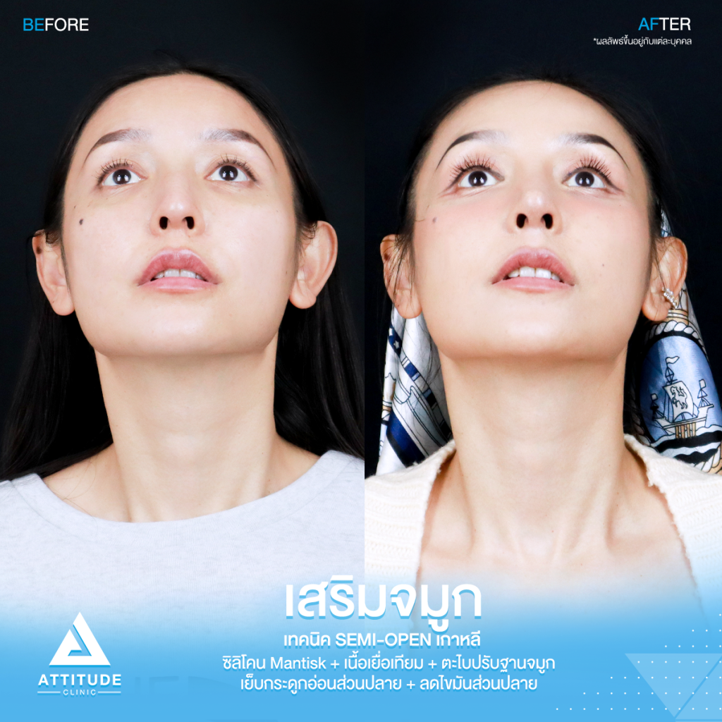 รีวิวเสริมจมูกคุณเฟียทส์ รีวิวเสริมจมูกคุณเฟียทส์ ด้วยซิลิโคน Mantisk เฉพาะปลายจมูก เคสจมูกมีฮัมพ์ ปลายงุ้ม ปรับโครงสร้างก่อนวางซิลิโคน เทคนิค Semi Open เกาหลี เน้นความเป็นธรรมชาติ โดยคุณหมอยุ้ย
