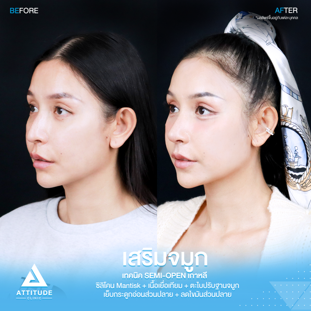 รีวิวเสริมจมูกคุณเฟียทส์ รีวิวเสริมจมูกคุณเฟียทส์ ด้วยซิลิโคน Mantisk เฉพาะปลายจมูก เคสจมูกมีฮัมพ์ ปลายงุ้ม ปรับโครงสร้างก่อนวางซิลิโคน เทคนิค Semi Open เกาหลี เน้นความเป็นธรรมชาติ โดยคุณหมอยุ้ย