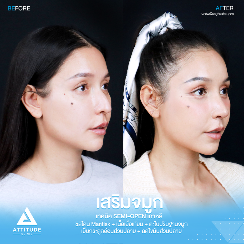 รีวิวเสริมจมูกคุณเฟียทส์ รีวิวเสริมจมูกคุณเฟียทส์ ด้วยซิลิโคน Mantisk เฉพาะปลายจมูก เคสจมูกมีฮัมพ์ ปลายงุ้ม ปรับโครงสร้างก่อนวางซิลิโคน เทคนิค Semi Open เกาหลี เน้นความเป็นธรรมชาติ โดยคุณหมอยุ้ย