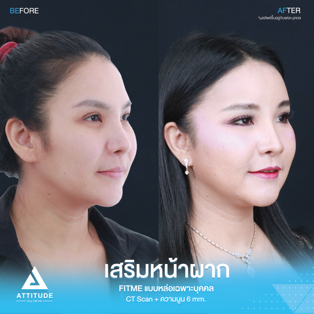 รีวิวเสริมหน้าผากคุณภัทร รีวิวเสริมหน้าผากคุณภัทร ด้วยซิลิโคน Fitme แบบ Ct Scan เฉพาะบุคคล ปรับรูปหน้า หน้าผากแบน เพิ่มความหวานละมุน เทคนิคซ่อนแผลในไรผม เจ็บน้อย สวยถาวร โดยคุณหมอยุ้ย