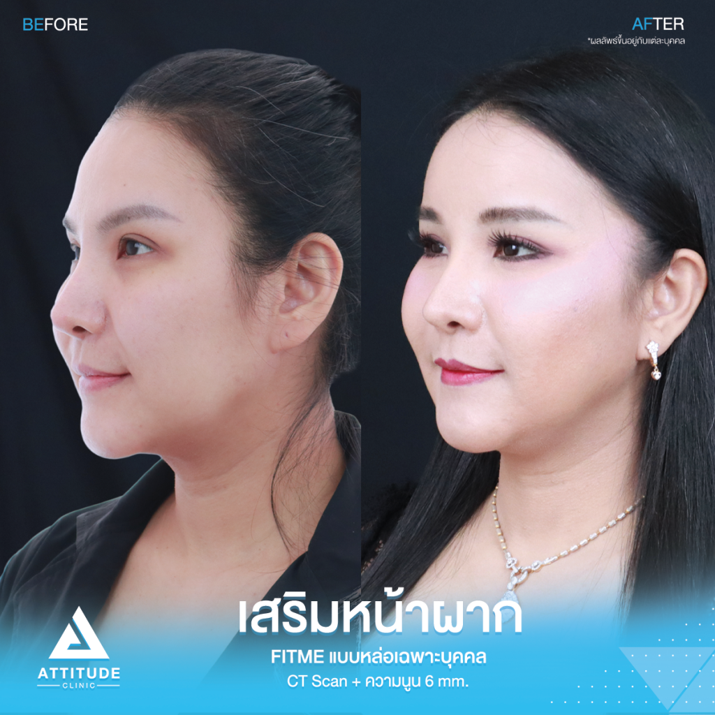รีวิวเสริมหน้าผากคุณภัทร รีวิวเสริมหน้าผากคุณภัทร ด้วยซิลิโคน Fitme แบบ Ct Scan เฉพาะบุคคล ปรับรูปหน้า หน้าผากแบน เพิ่มความหวานละมุน เทคนิคซ่อนแผลในไรผม เจ็บน้อย สวยถาวร โดยคุณหมอยุ้ย