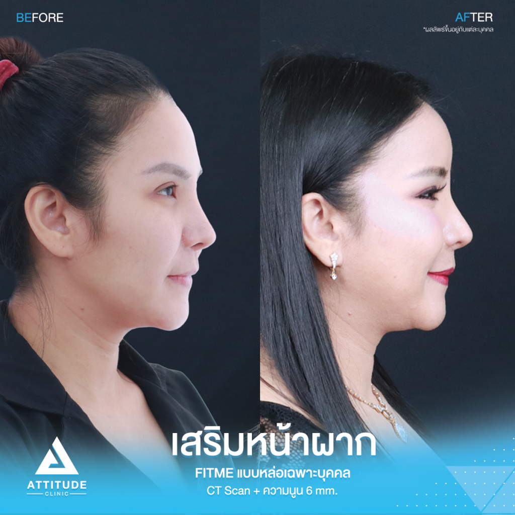 รีวิวเสริมหน้าผากคุณภัทร รีวิวเสริมหน้าผากคุณภัทร ด้วยซิลิโคน Fitme แบบ Ct Scan เฉพาะบุคคล ปรับรูปหน้า หน้าผากแบน เพิ่มความหวานละมุน เทคนิคซ่อนแผลในไรผม เจ็บน้อย สวยถาวร โดยคุณหมอยุ้ย