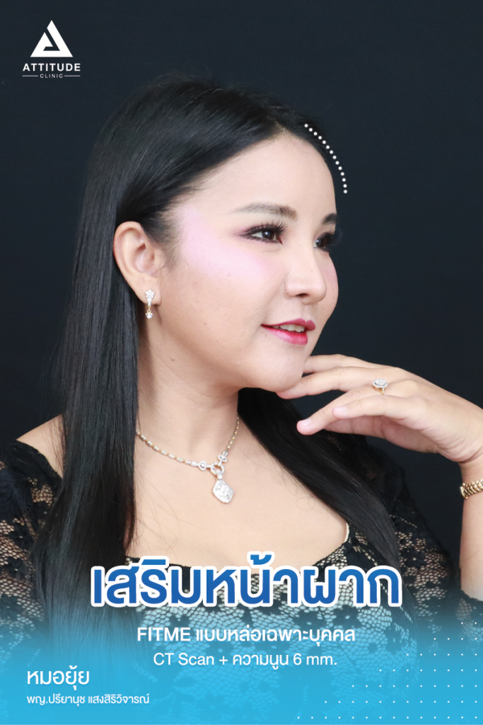 รีวิวเสริมหน้าผากคุณภัทร ด้วยซิลิโคน Fitme แบบ Ct Scan เฉพาะบุคคล ปรับรูปหน้า หน้าผากแบน เพิ่มความหวานละมุน เทคนิคซ่อนแผลในไรผม เจ็บน้อย สวยถาวร โดยคุณหมอยุ้ย