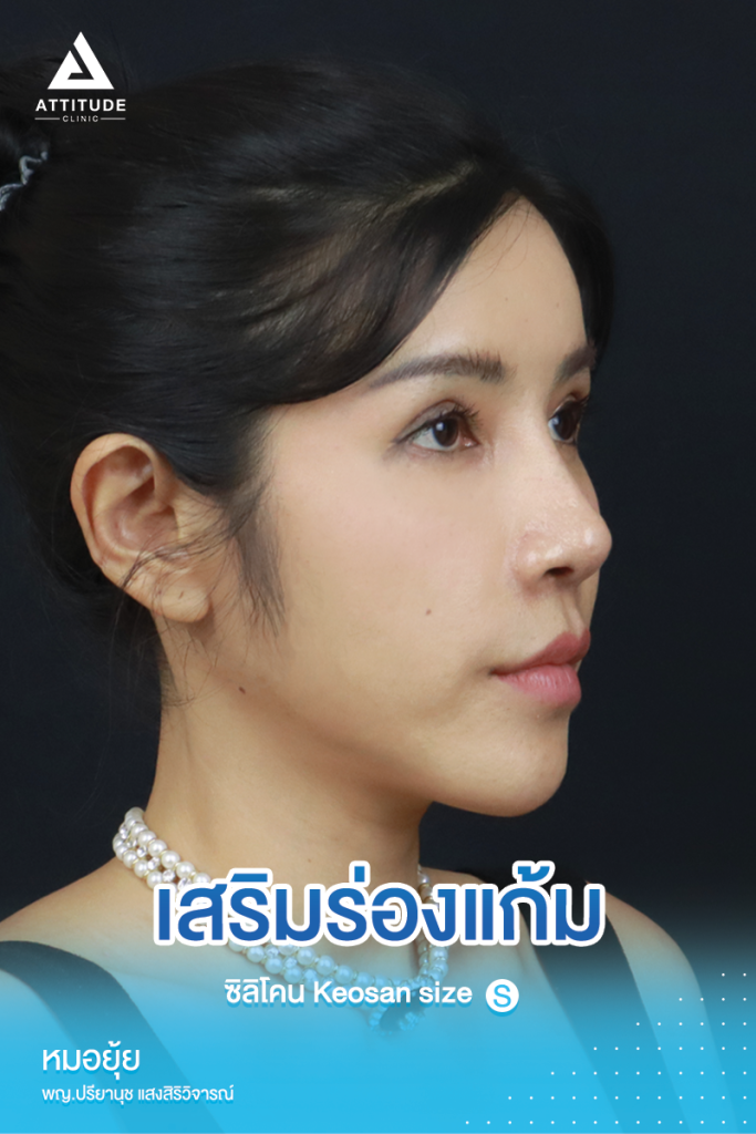 หน้าเด็กเกินต้าน!  รีวิวเสริมซิลิโคนร่องแก้ม ซิลิโคร Keosan size S ปรับหน้าสวยหวาน ปลอดภัยถาวร โดยหมอยุ้ย Attitude Clinic รัชดา