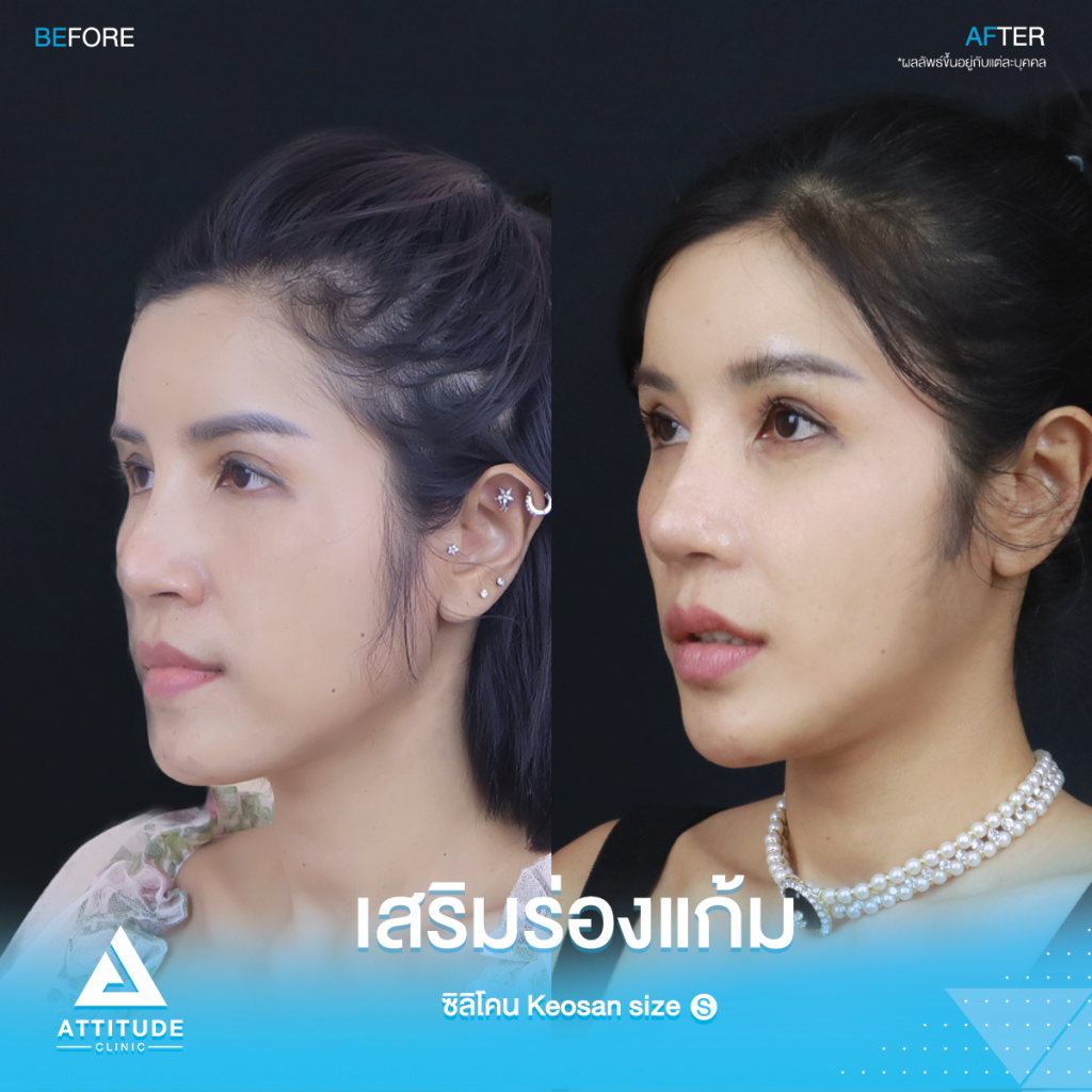 รีวิวเสริมซิลิโคนร่องแก้ม หน้าเด็กเกินต้าน! รีวิวเสริมซิลิโคนร่องแก้ม ซิลิโคร Keosan size S ปรับหน้าสวยหวาน ปลอดภัยถาวร โดยหมอยุ้ย Attitude Clinic รัชดา