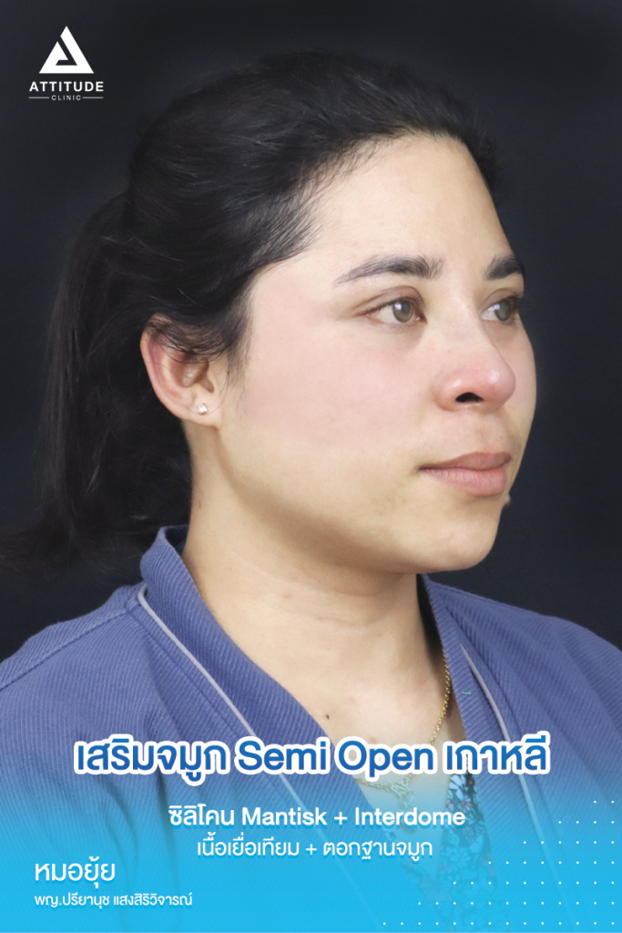 จมูกสวยเป๊ะถาวร รีวิวเสริมจมูกคุณยา เทคนิค Semi Open เกาหลี ซิลิโคน Mantisk แก้ปัญหาจมูกปลายงุ้มตก ทำให้หน้าดูดุ เน้นความเป็นธรรมชาติ โดยคุณหมอยุ้ย