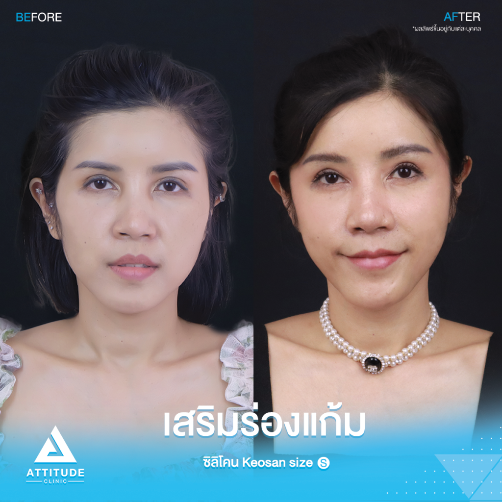 รีวิวเสริมซิลิโคนร่องแก้ม หน้าเด็กเกินต้าน! รีวิวเสริมซิลิโคนร่องแก้ม ซิลิโคร Keosan size S ปรับหน้าสวยหวาน ปลอดภัยถาวร โดยหมอยุ้ย Attitude Clinic รัชดา