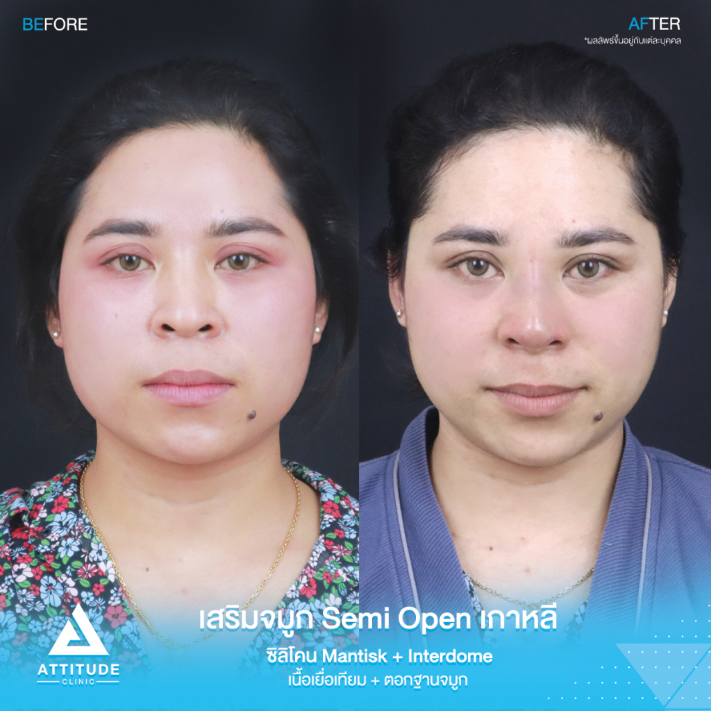 จมูกสวยเป๊ะถาวร รีวิวเสริมจมูกคุณยา เทคนิค Semi Open เกาหลี ซิลิโคน Mantisk แก้ปัญหาจมูกปลายงุ้มตก ทำให้หน้าดูดุ เน้นความเป็นธรรมชาติ โดยคุณหมอยุ้ย