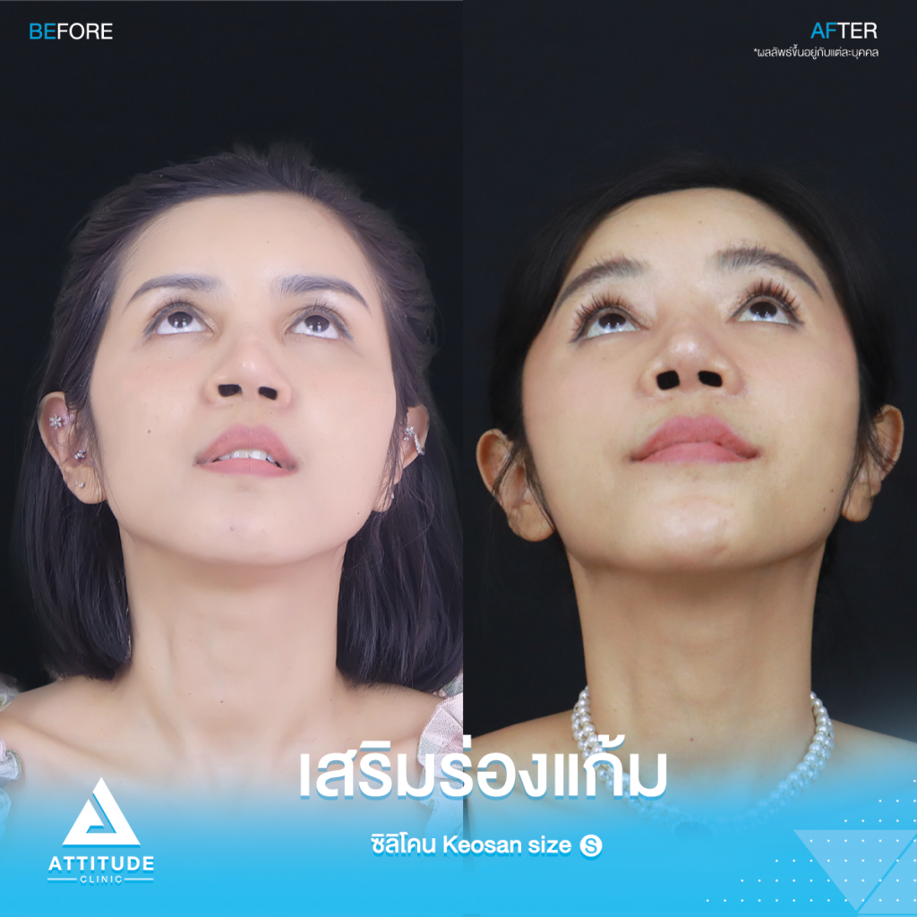 รีวิวเสริมซิลิโคนร่องแก้ม หน้าเด็กเกินต้าน! รีวิวเสริมซิลิโคนร่องแก้ม ซิลิโคร Keosan size S ปรับหน้าสวยหวาน ปลอดภัยถาวร โดยหมอยุ้ย Attitude Clinic รัชดา