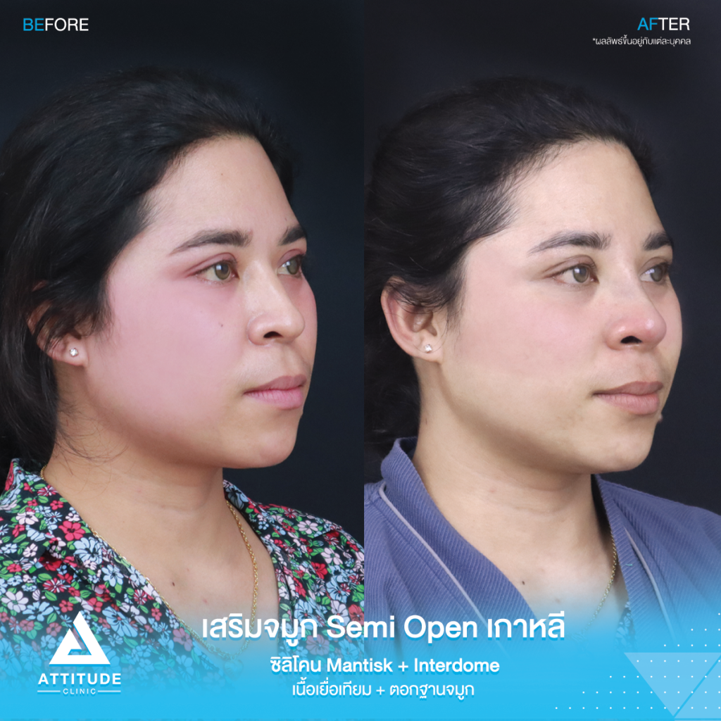 จมูกสวยเป๊ะถาวร รีวิวเสริมจมูกคุณยา เทคนิค Semi Open เกาหลี ซิลิโคน Mantisk แก้ปัญหาจมูกปลายงุ้มตก ทำให้หน้าดูดุ เน้นความเป็นธรรมชาติ โดยคุณหมอยุ้ย