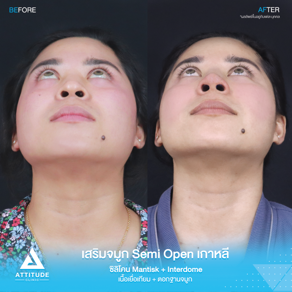 จมูกสวยเป๊ะถาวร รีวิวเสริมจมูกคุณยา เทคนิค Semi Open เกาหลี ซิลิโคน Mantisk แก้ปัญหาจมูกปลายงุ้มตก ทำให้หน้าดูดุ เน้นความเป็นธรรมชาติ โดยคุณหมอยุ้ย