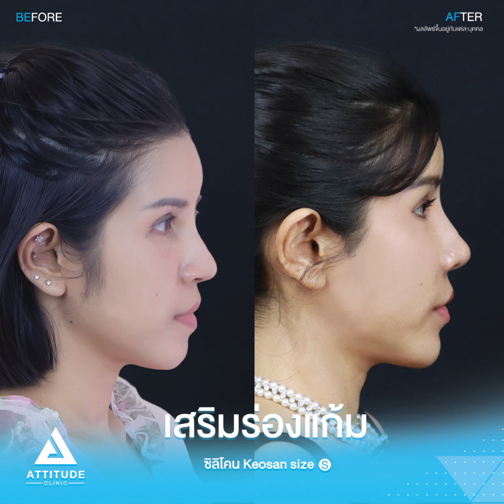 รีวิวเสริมซิลิโคนร่องแก้ม