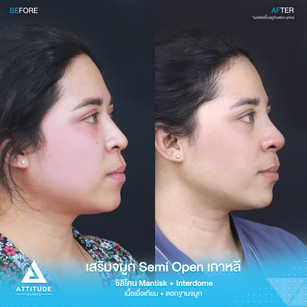 จมูกสวยเป๊ะถาวร รีวิวเสริมจมูกคุณยา เทคนิค Semi Open เกาหลี ซิลิโคน Mantisk แก้ปัญหาจมูกปลายงุ้มตก ทำให้หน้าดูดุ เน้นความเป็นธรรมชาติ โดยคุณหมอยุ้ย