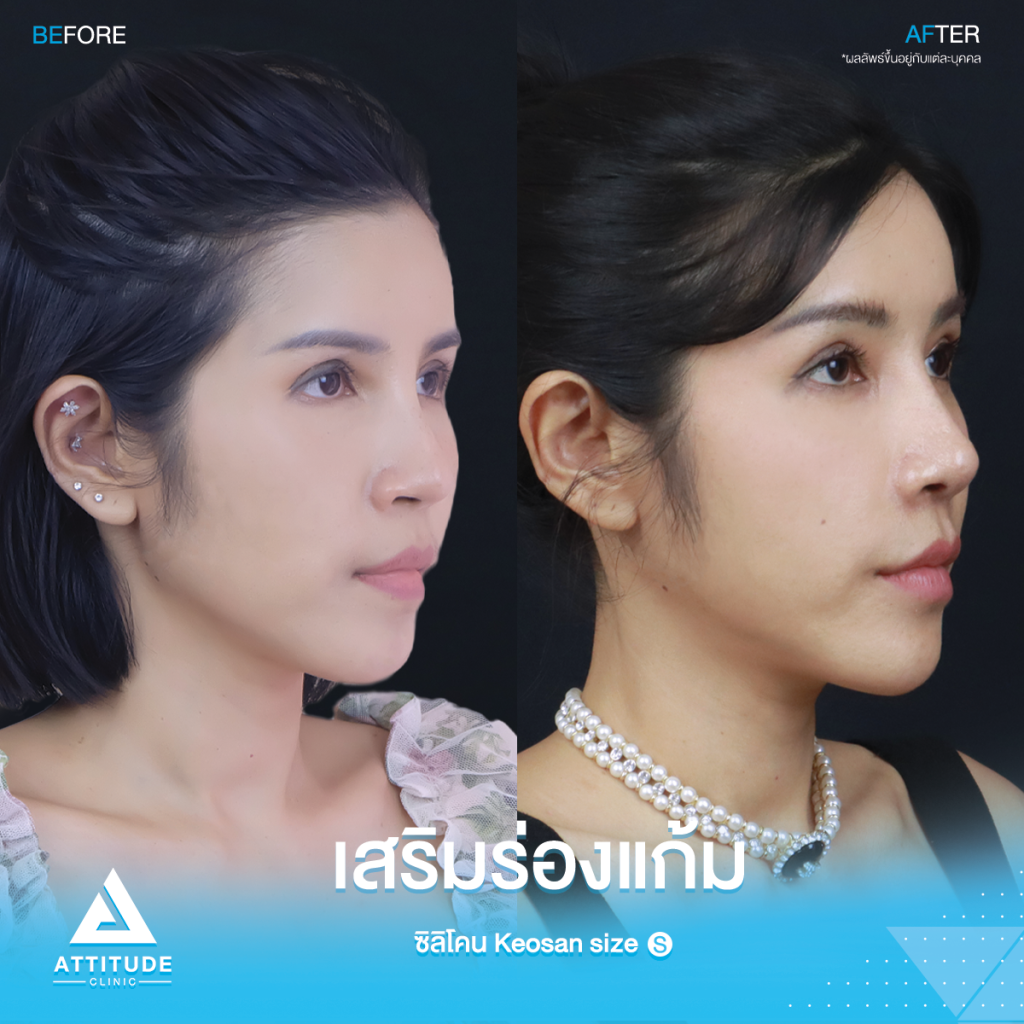 หน้าเด็กเกินต้าน! รีวิวเสริมซิลิโคนร่องแก้ม ซิลิโคน Keosan size S ปรับหน้าสวยหวาน ปลอดภัยถาวร โดยหมอยุ้ย Attitude Clinic รัชดา