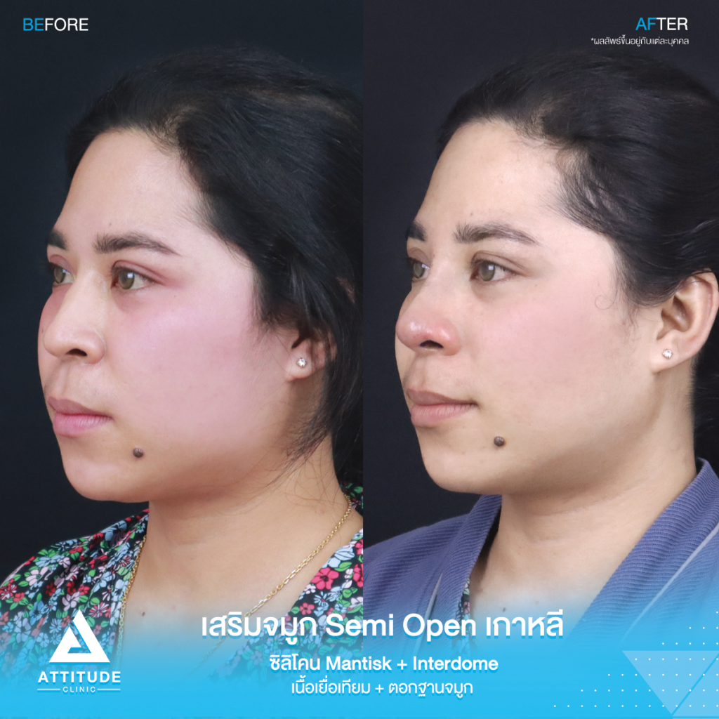 จมูกสวยเป๊ะถาวร รีวิวเสริมจมูกคุณยา เทคนิค Semi Open เกาหลี ซิลิโคน Mantisk แก้ปัญหาจมูกปลายงุ้มตก ทำให้หน้าดูดุ เน้นความเป็นธรรมชาติ โดยคุณหมอยุ้ย