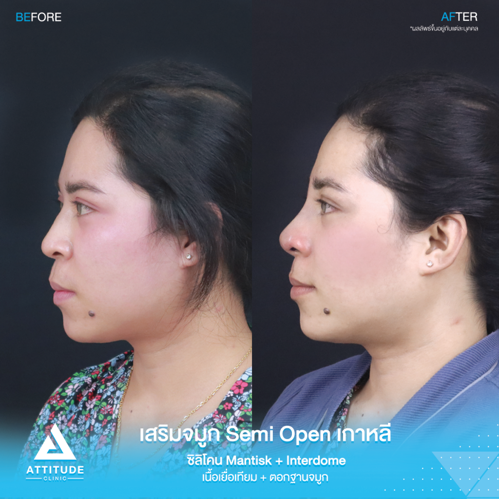 จมูกสวยเป๊ะถาวร รีวิวเสริมจมูกคุณยา เทคนิค Semi Open เกาหลี ซิลิโคน Mantisk แก้ปัญหาจมูกปลายงุ้มตก ทำให้หน้าดูดุ เน้นความเป็นธรรมชาติ โดยคุณหมอยุ้ย
