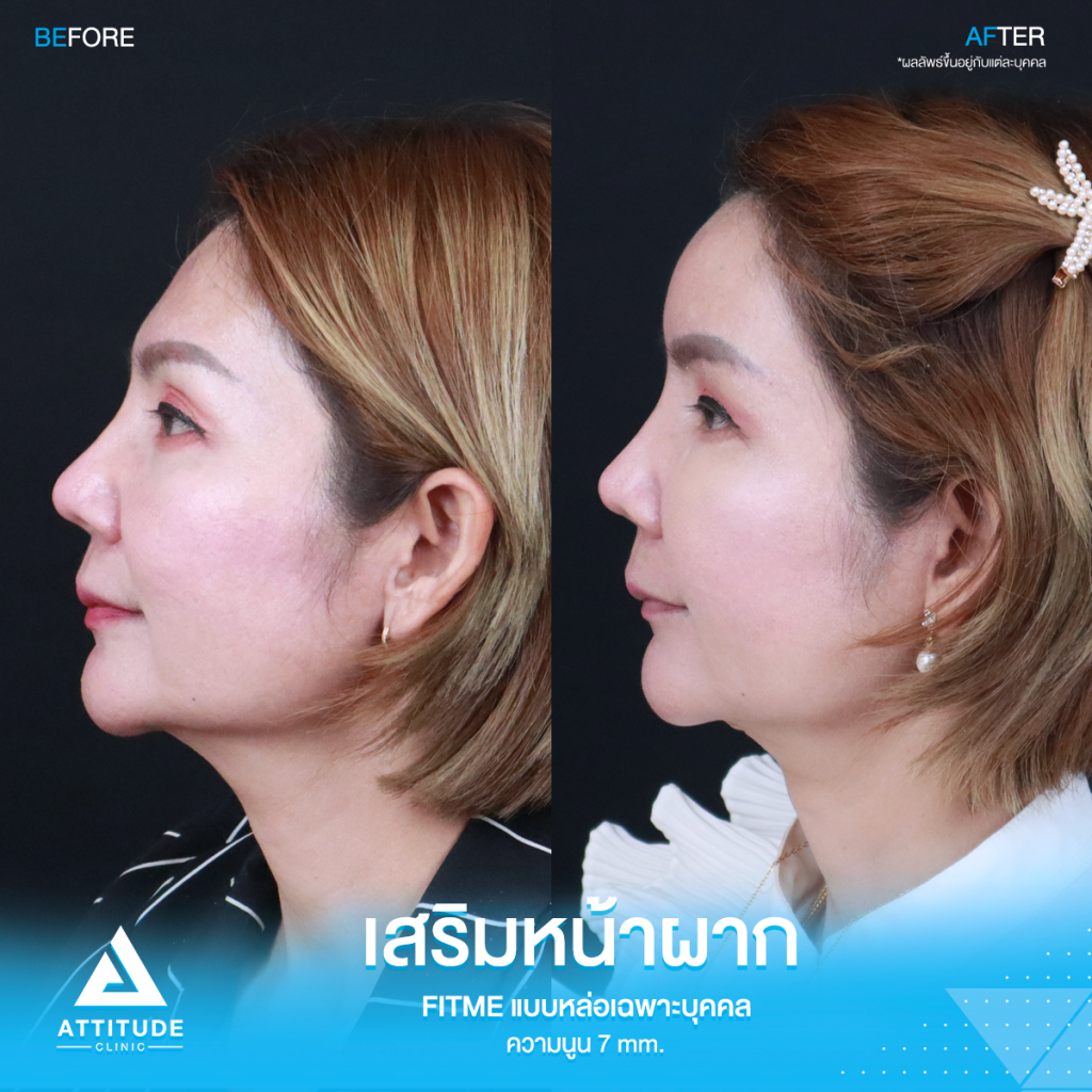 รีวิวเสริมหน้าผากคุณรัก ด้วยซิลิโคน Fitme แบบหล่อเฉพาะบุคคล ปรับรูปหน้า หน้าผากแบน เพิ่มความหวานละมุน โดยคุณหมอยุ้ย