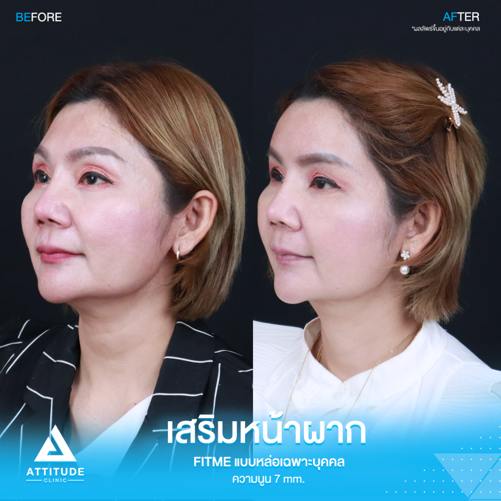 รีวิวเสริมหน้าผากคุณรัก รีวิวเสริมหน้าผาก คุณแจน ด้วยซิลิโคน Fitme แบบหล่อเฉพาะบุคคล แก้ปัญหาโหนกคิ้วสูง ตรงกลางนูนไม่เสมอกัน เสริมด้วยความนูนพอดี รับกับรูปหน้า สวยหวาน ไม่โป๊ะ