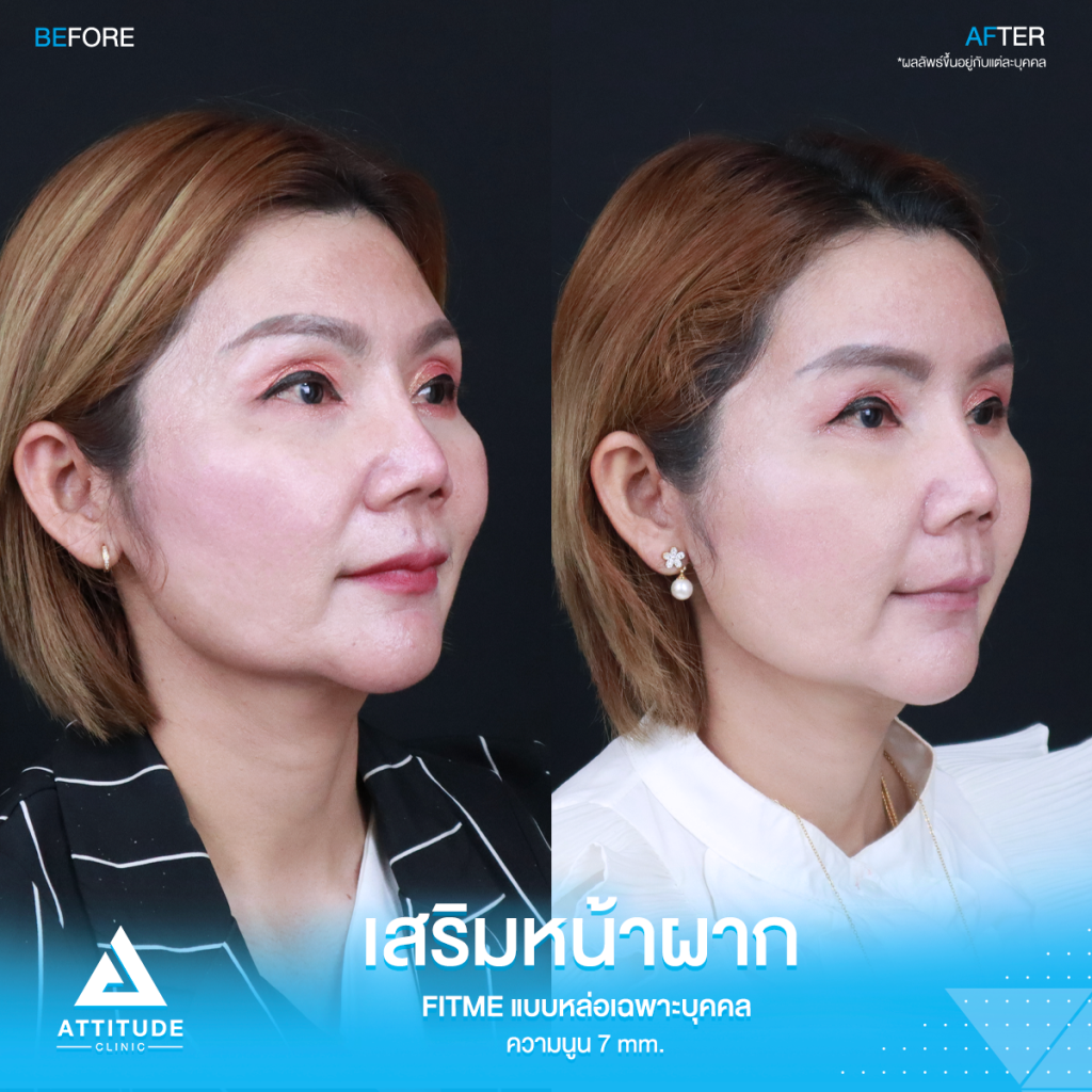 รีวิวเสริมหน้าผากคุณรัก ด้วยซิลิโคน Fitme แบบหล่อเฉพาะบุคคล ปรับรูปหน้า หน้าผากแบน เพิ่มความหวานละมุน โดยคุณหมอยุ้ย