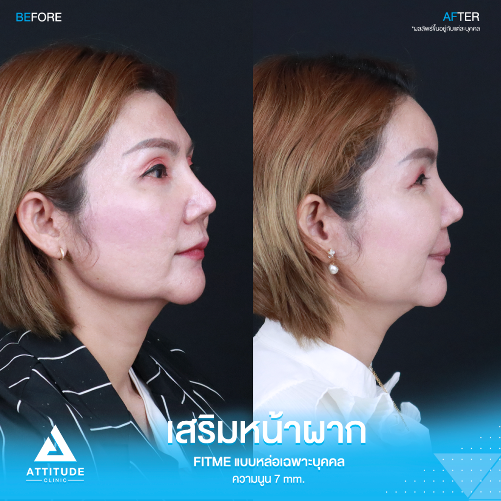 รีวิวเสริมหน้าผากคุณรัก รีวิวเสริมหน้าผาก คุณแจน ด้วยซิลิโคน Fitme แบบหล่อเฉพาะบุคคล แก้ปัญหาโหนกคิ้วสูง ตรงกลางนูนไม่เสมอกัน เสริมด้วยความนูนพอดี รับกับรูปหน้า สวยหวาน ไม่โป๊ะ