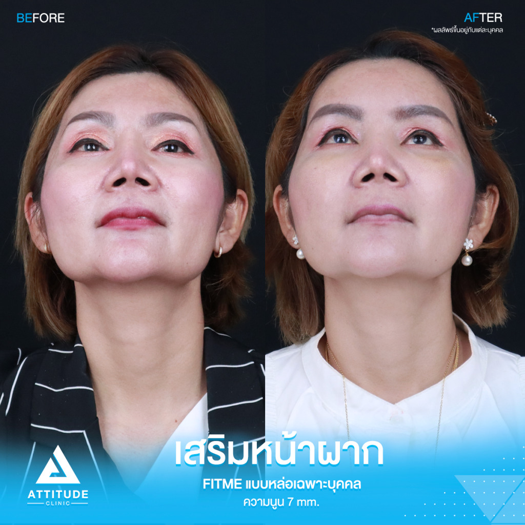 รีวิวเสริมหน้าผากคุณรัก รีวิวเสริมหน้าผาก คุณแจน ด้วยซิลิโคน Fitme แบบหล่อเฉพาะบุคคล แก้ปัญหาโหนกคิ้วสูง ตรงกลางนูนไม่เสมอกัน เสริมด้วยความนูนพอดี รับกับรูปหน้า สวยหวาน ไม่โป๊ะ