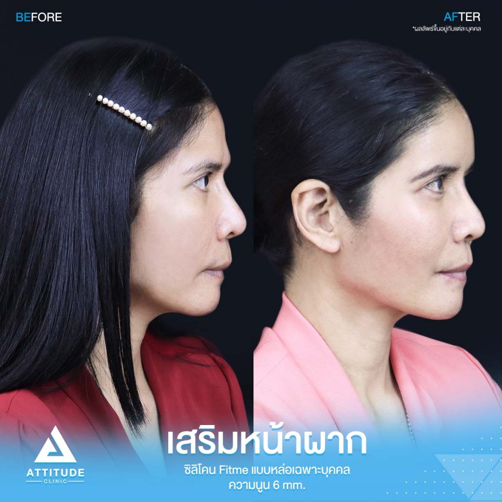รีวิวเสริมหน้าผากคุณอุ๊ ด้วยซิลิโคน Fitme แบบหล่อเฉพาะบุคคล แก้ปัญหาโหนกคิ้วสูง หน้าดูดุ ดูแก่กว่าวัย โดยคุณหมอยุ้ย