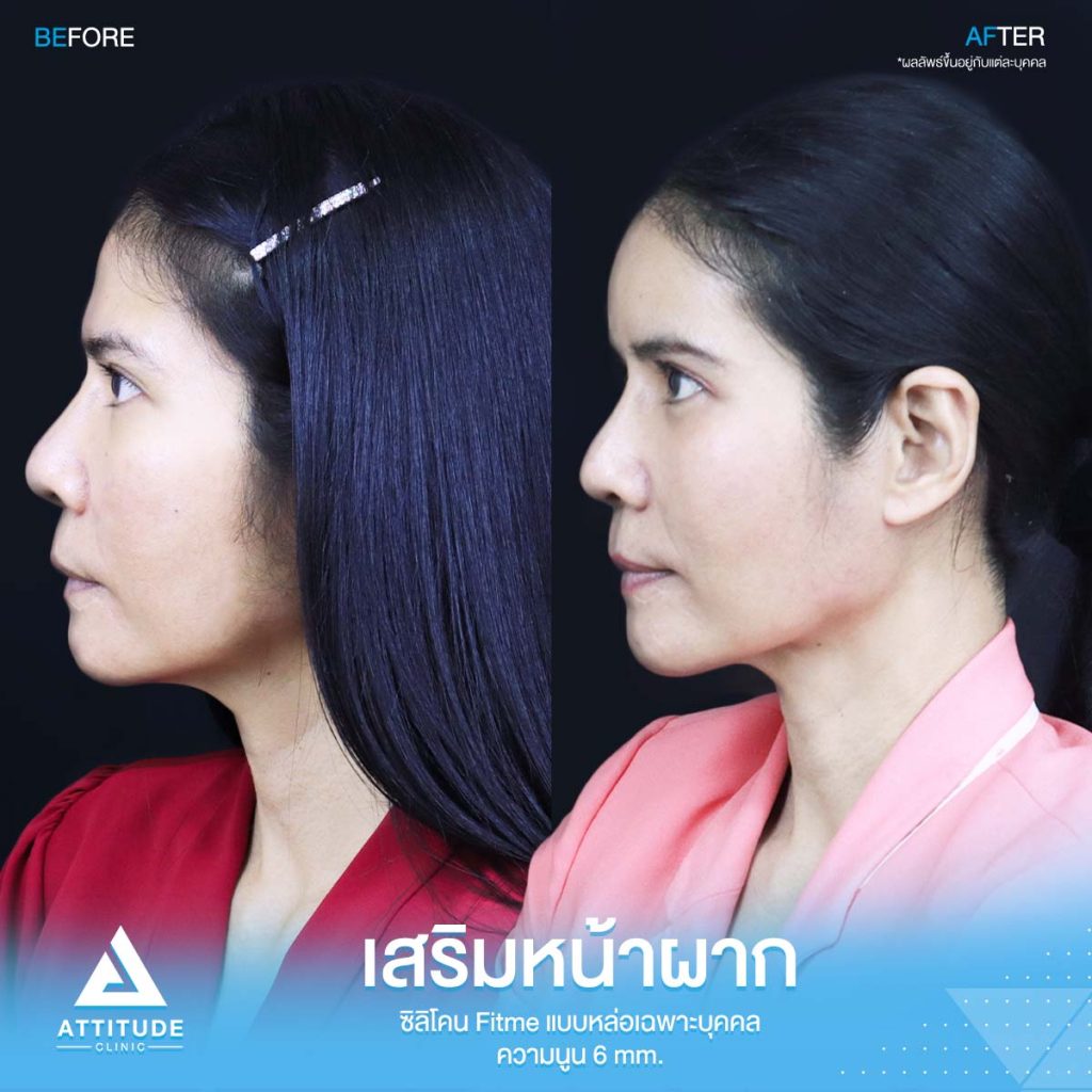 รีวิวเสริมหน้าผากคุณอุ๊ รีวิวเสริมหน้าผากคุณอุ๊ ด้วยซิลิโคน Fitme แบบหล่อเฉพาะบุคคล แก้ปัญหาโหนกคิ้วสูง หน้าดูดุ ดูแก่กว่าวัย โดยคุณหมอยุ้ย