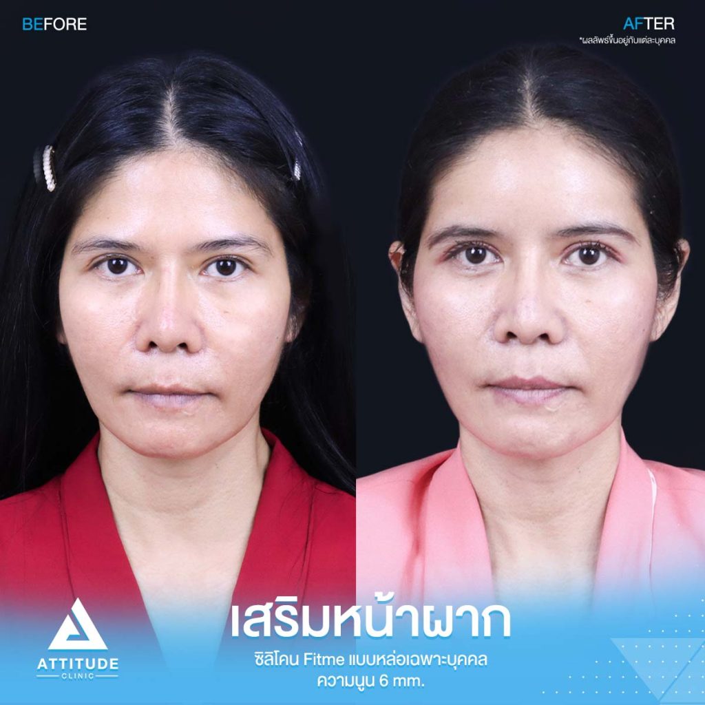 รีวิวเสริมหน้าผากคุณอุ๊ รีวิวเสริมหน้าผากคุณอุ๊ ด้วยซิลิโคน Fitme แบบหล่อเฉพาะบุคคล แก้ปัญหาโหนกคิ้วสูง หน้าดูดุ ดูแก่กว่าวัย โดยคุณหมอยุ้ย