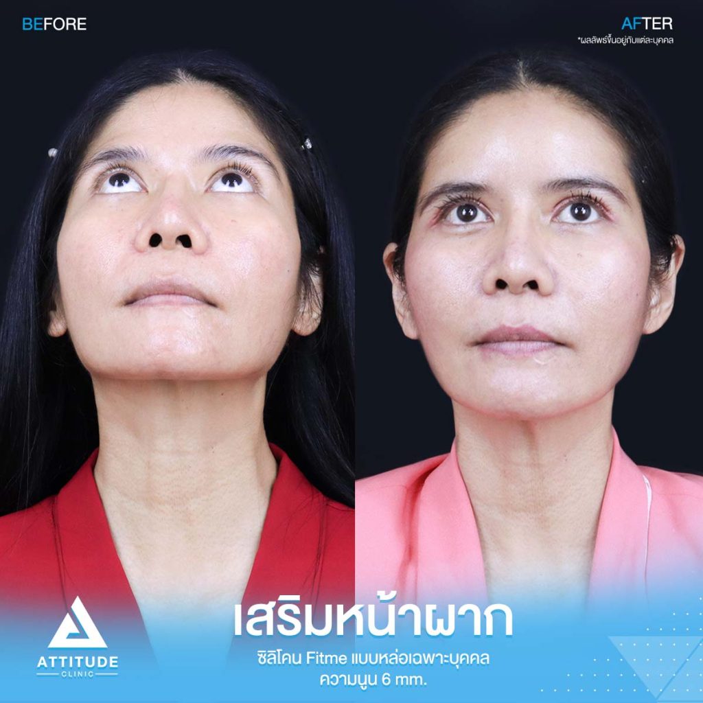 รีวิวเสริมหน้าผากคุณอุ๊ รีวิวเสริมหน้าผากคุณอุ๊ ด้วยซิลิโคน Fitme แบบหล่อเฉพาะบุคคล แก้ปัญหาโหนกคิ้วสูง หน้าดูดุ ดูแก่กว่าวัย โดยคุณหมอยุ้ย