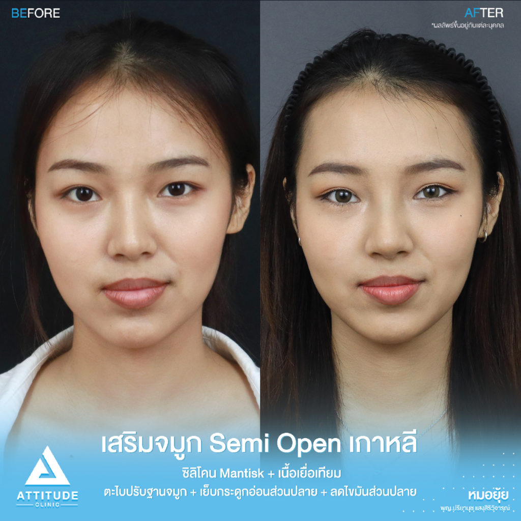 รีวิวแก้จมูกคุณแอน รีวิวแก้จมูกคุณแอน ปลายตึง แกนเอียงใกล้ทะลุ ด้วยซิลิโคน Mantisk ปรับครงสร้างก่อนวางซิลิโคน เทคนิค Semi Open เกาหลี เป็นธรรมชาติ สวยหวานละมุน โดยคุณหมอยุ้ย