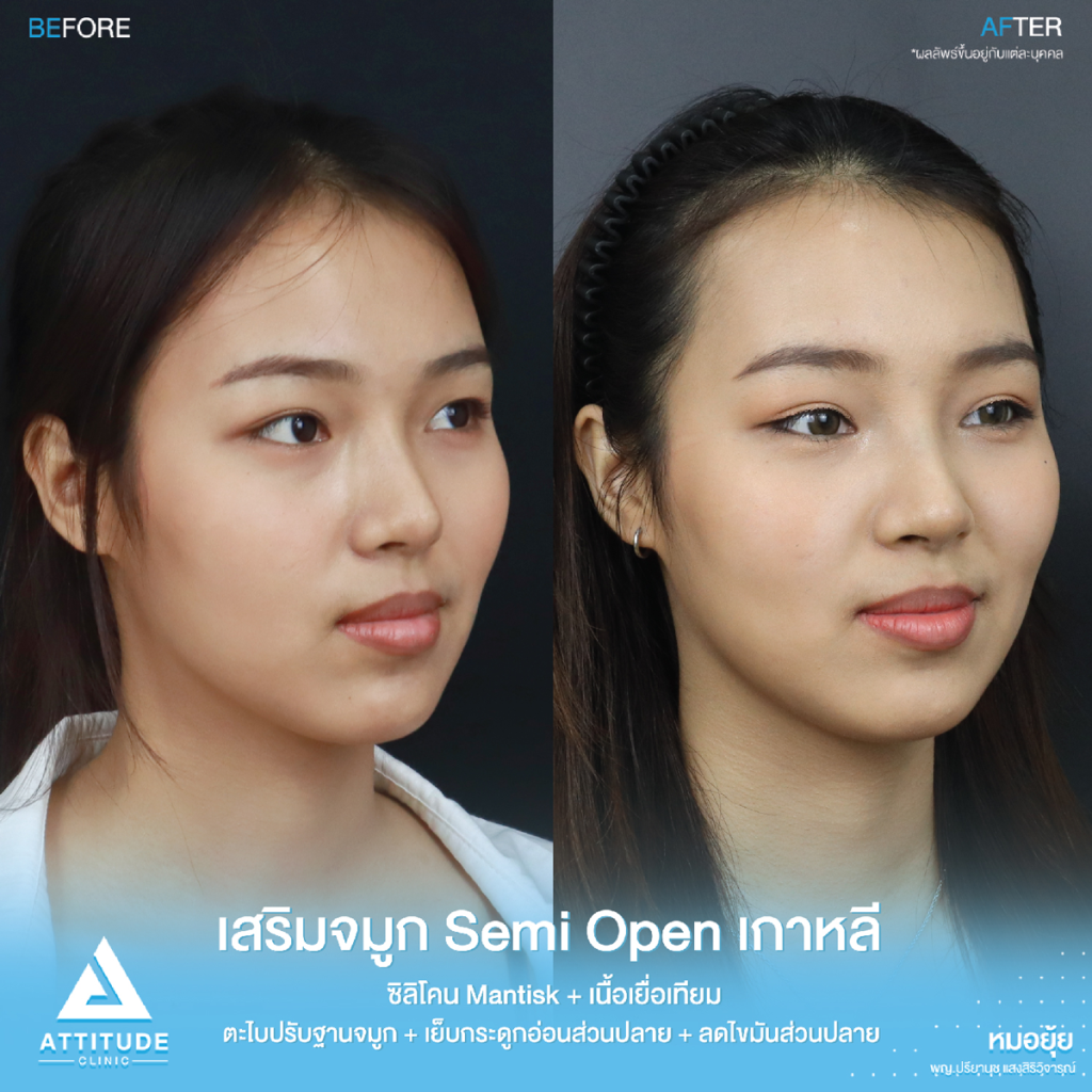 รีวิวแก้จมูกคุณแอน รีวิวแก้จมูกคุณแอน ปลายตึง แกนเอียงใกล้ทะลุ ด้วยซิลิโคน Mantisk ปรับครงสร้างก่อนวางซิลิโคน เทคนิค Semi Open เกาหลี เป็นธรรมชาติ สวยหวานละมุน โดยคุณหมอยุ้ย