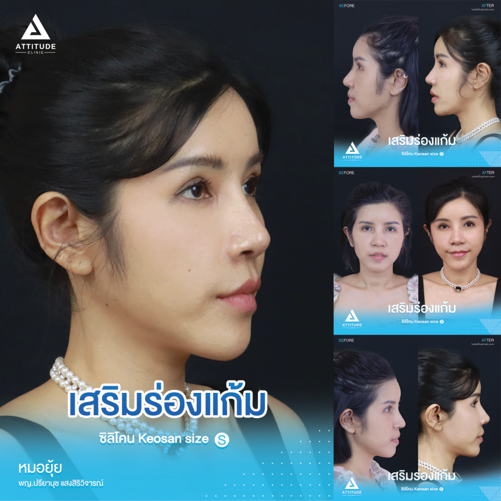 หน้าเด็กเกินต้าน! รีวิวเสริมซิลิโคนร่องแก้ม ซิลิโคน Keosan size S ปรับหน้าสวยหวาน ปลอดภัยถาวร โดยหมอยุ้ย Attitude Clinic รัชดา