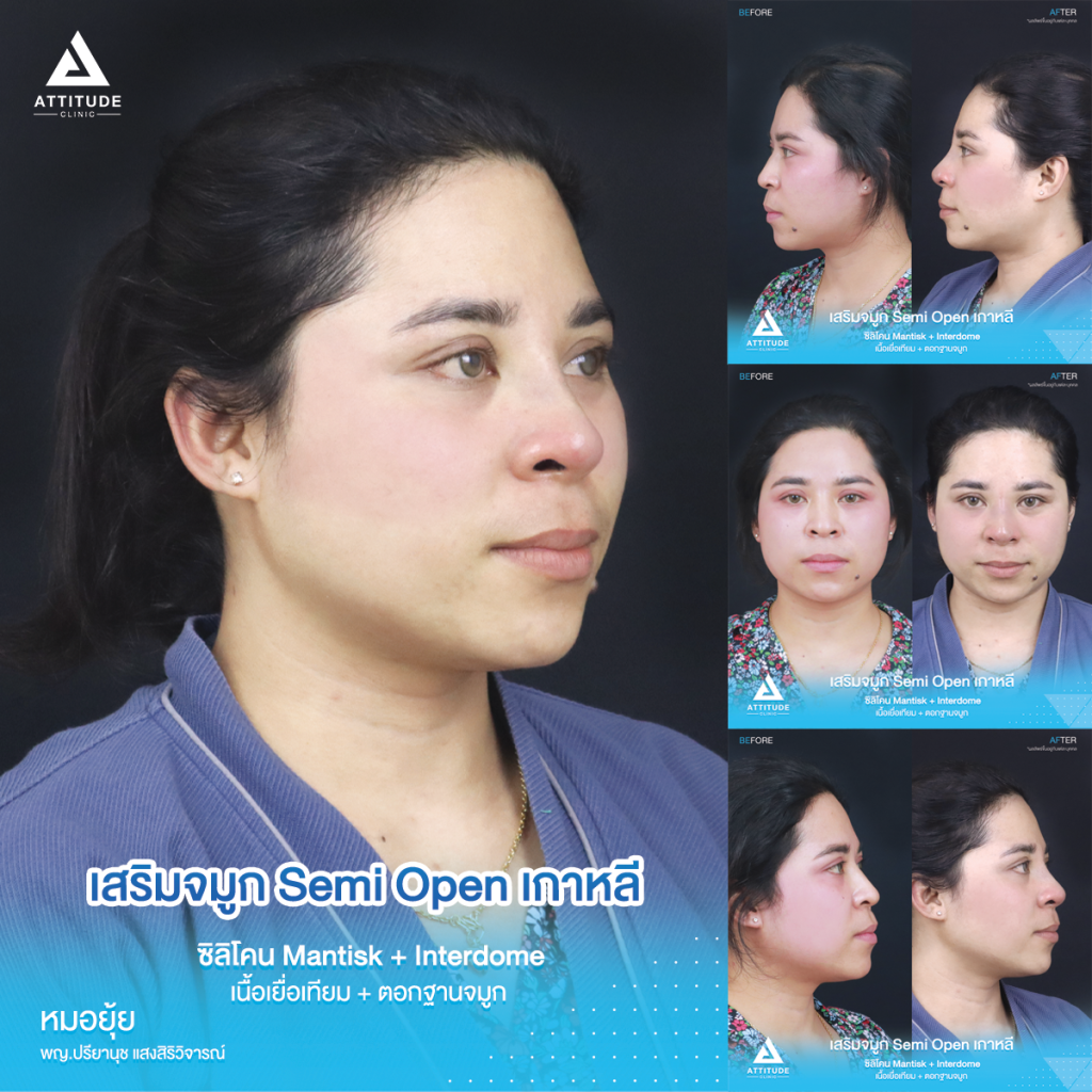 จมูกสวยเป๊ะถาวร รีวิวเสริมจมูกคุณยา เทคนิค Semi Open เกาหลี ซิลิโคน Mantisk แก้ปัญหาจมูกปลายงุ้มตก ทำให้หน้าดูดุ เน้นความเป็นธรรมชาติ โดยคุณหมอยุ้ย