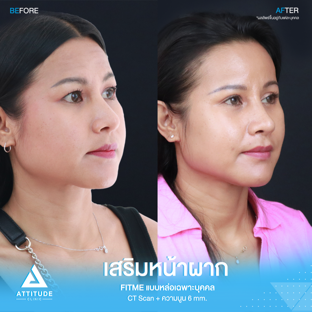 รีวิวเสริมหน้าผากคุณโบ หน้าผากสวยฉ่ำเต็มสิบ! ไม่มีหัก รีวิวเสริมหน้าผากคุณโบ S Curve ซิลิโคน Fitme เฉพาะบุคคลด้วยวิธี CT Scan เคยเสริมหน้าผากสำเร็จรูปมาก่อน ซิลิโคนไม่พอดีกับหน้าผาก มาแก้ใหม่ให้สวยเป๊ะกับหมอยุ้ย