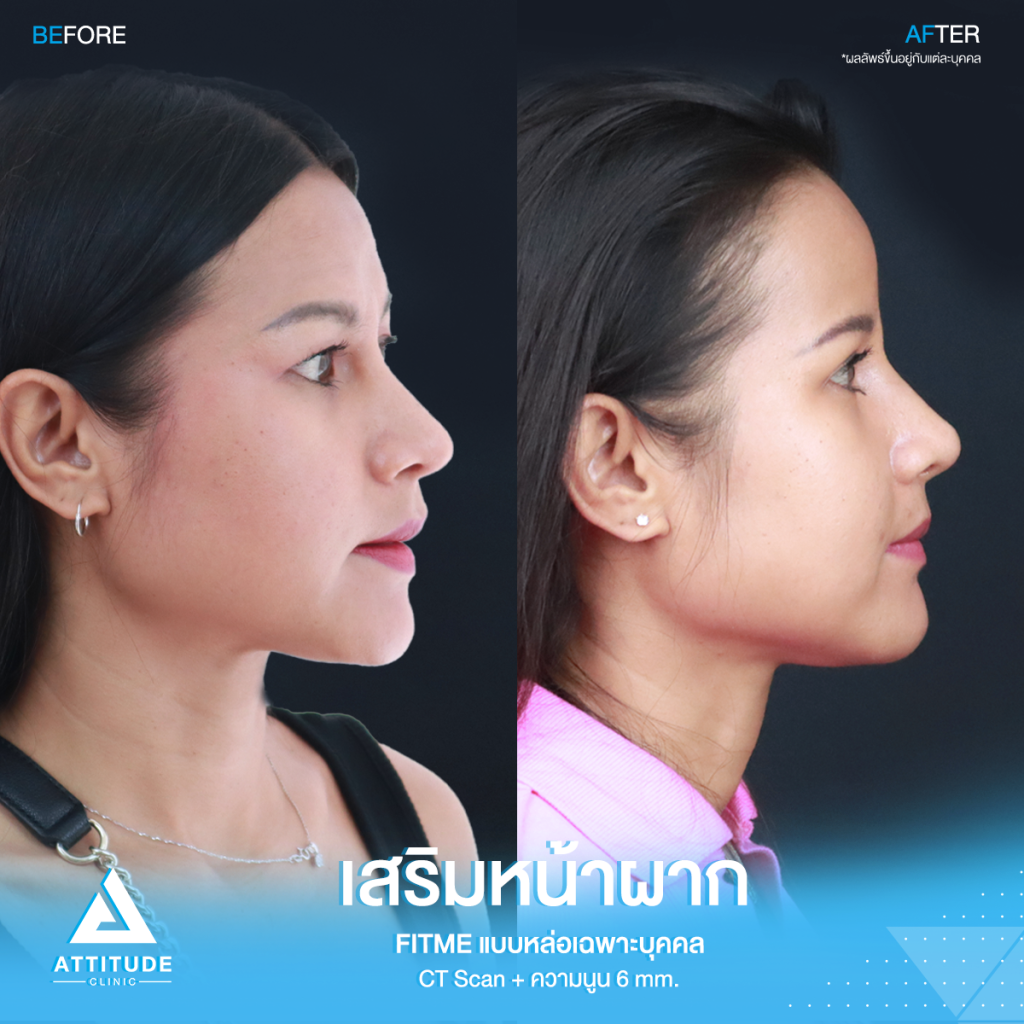 รีวิวเสริมหน้าผากคุณโบ หน้าผากสวยฉ่ำเต็มสิบ! ไม่มีหัก รีวิวเสริมหน้าผากคุณโบ S Curve ซิลิโคน Fitme เฉพาะบุคคลด้วยวิธี CT Scan เคยเสริมหน้าผากสำเร็จรูปมาก่อน ซิลิโคนไม่พอดีกับหน้าผาก มาแก้ใหม่ให้สวยเป๊ะกับหมอยุ้ย