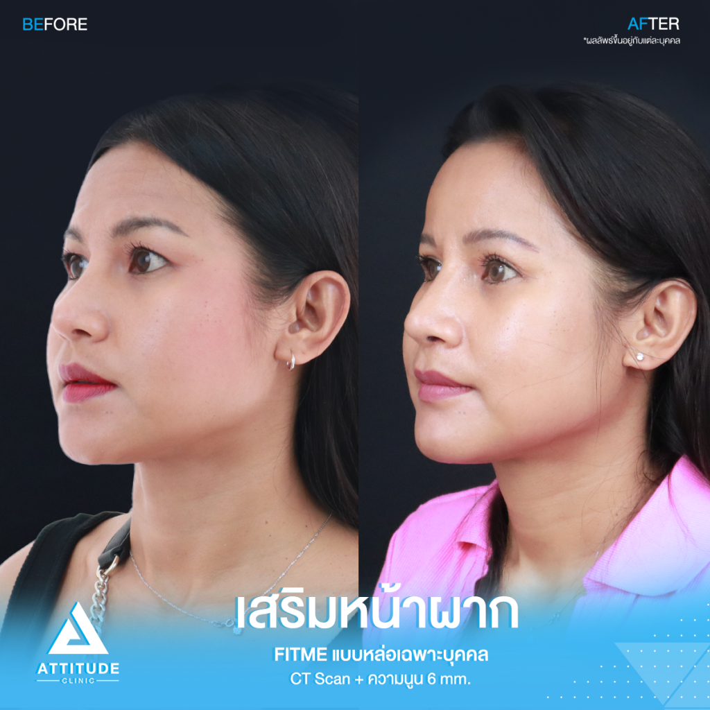 รีวิวเสริมหน้าผากคุณโบ หน้าผากสวยฉ่ำเต็มสิบ! ไม่มีหัก รีวิวเสริมหน้าผากคุณโบ S Curve ซิลิโคน Fitme เฉพาะบุคคลด้วยวิธี CT Scan เคยเสริมหน้าผากสำเร็จรูปมาก่อน ซิลิโคนไม่พอดีกับหน้าผาก มาแก้ใหม่ให้สวยเป๊ะกับหมอยุ้ย