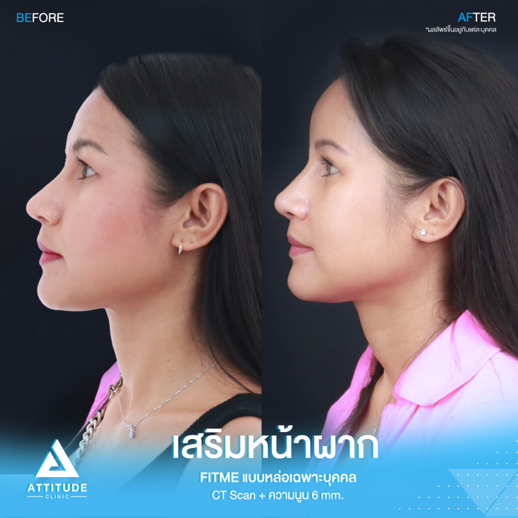 รีวิวเสริมหน้าผากคุณโบ หน้าผากสวยฉ่ำเต็มสิบ! ไม่มีหัก รีวิวเสริมหน้าผากคุณโบ S Curve ซิลิโคน Fitme เฉพาะบุคคลด้วยวิธี CT Scan เคยเสริมหน้าผากสำเร็จรูปมาก่อน ซิลิโคนไม่พอดีกับหน้าผาก มาแก้ใหม่ให้สวยเป๊ะกับหมอยุ้ย