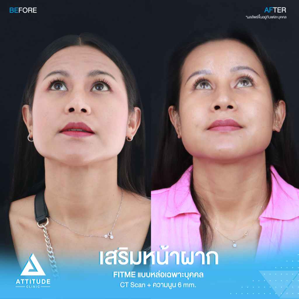 รีวิวเสริมหน้าผากคุณโบ หน้าผากสวยฉ่ำเต็มสิบ! ไม่มีหัก รีวิวเสริมหน้าผากคุณโบ S Curve ซิลิโคน Fitme เฉพาะบุคคลด้วยวิธี CT Scan เคยเสริมหน้าผากสำเร็จรูปมาก่อน ซิลิโคนไม่พอดีกับหน้าผาก มาแก้ใหม่ให้สวยเป๊ะกับหมอยุ้ย