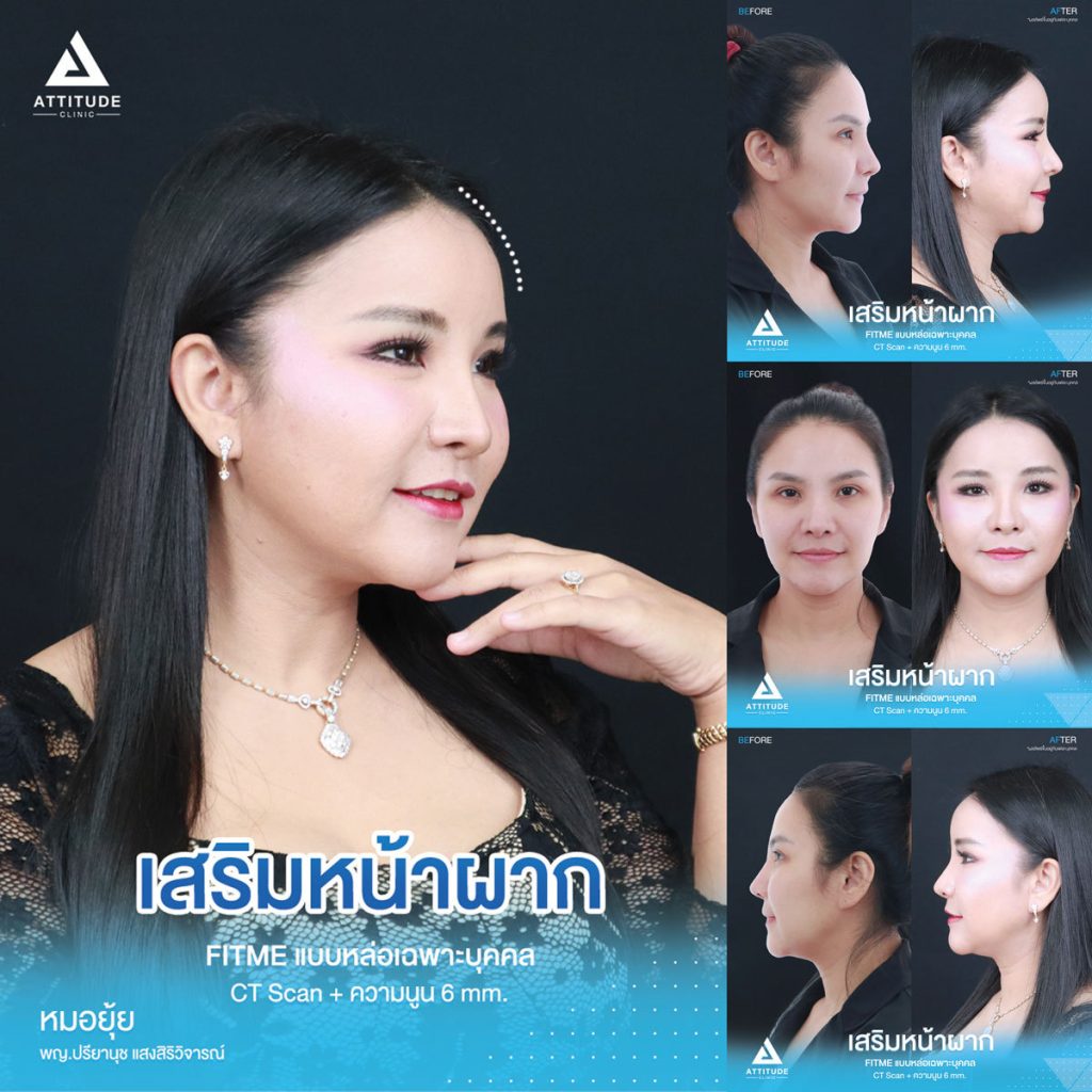 รีวิวเสริมหน้าผากคุณภัทร ด้วยซิลิโคน Fitme แบบ Ct Scan เฉพาะบุคคล ปรับรูปหน้า หน้าผากแบน เพิ่มความหวานละมุน เทคนิคซ่อนแผลในไรผม เจ็บน้อย สวยถาวร โดยคุณหมอยุ้ย