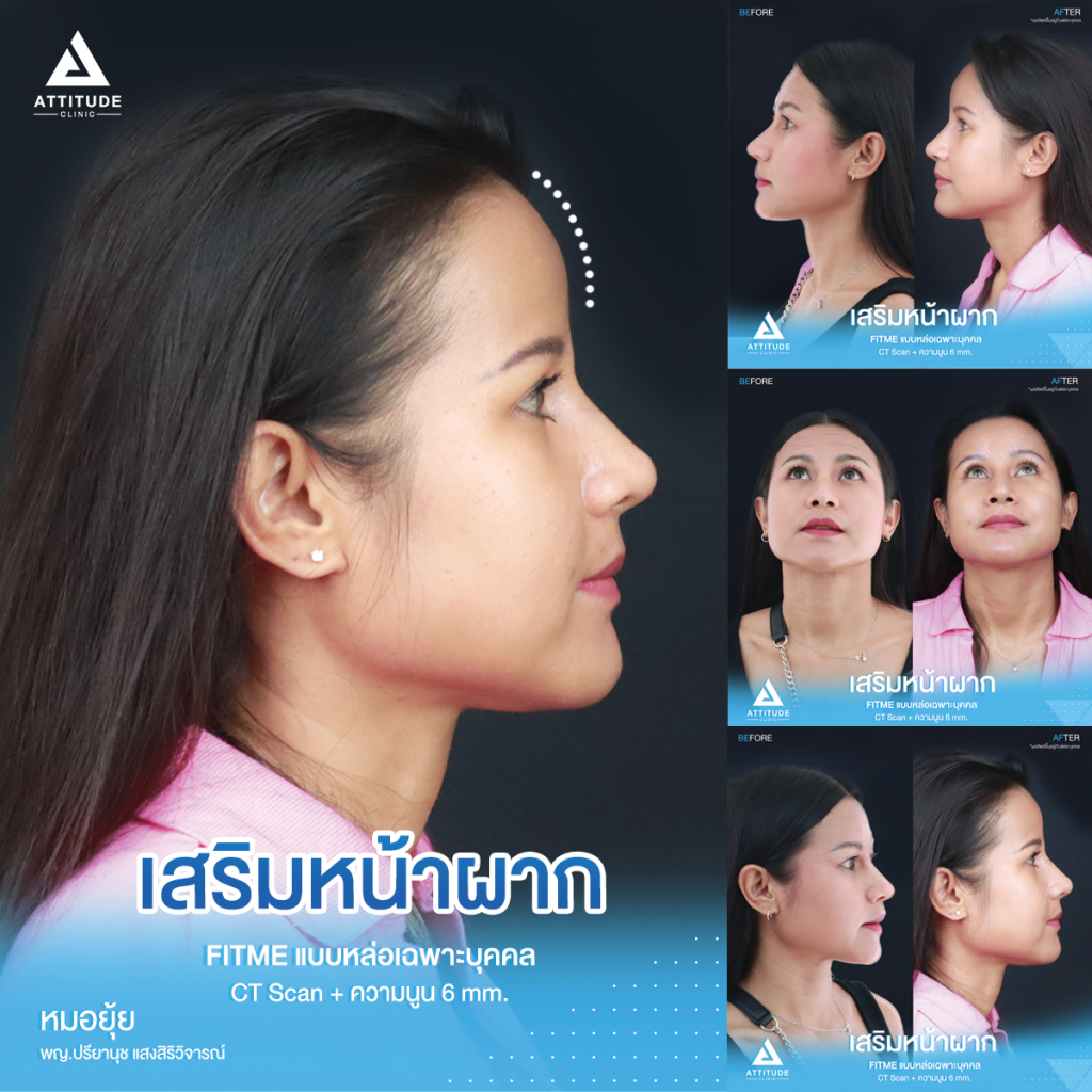 หน้าผากสวยฉ่ำเต็มสิบ! ไม่มีหัก รีวิวเสริมหน้าผากคุณโบ S Curve ซิลิโคน Fitme เฉพาะบุคคลด้วยวิธี CT Scan เคยเสริมหน้าผากสำเร็จรูปมาก่อน ซิลิโคนไม่พอดีกับหน้าผาก มาแก้ใหม่ให้สวยเป๊ะกับหมอยุ้ย