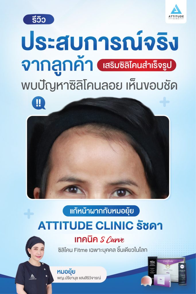 รีวิวประสบการณ์จริงจากคุณลูกค้า เกิดปัญหาซิลิโคนลอย เห็นขอบ มาแก้หน้าผาก S Curve ซิลิโคน Fitme เฉพาะบุคคล กับหมอยุ้ย Attitude Clinic รัชดา