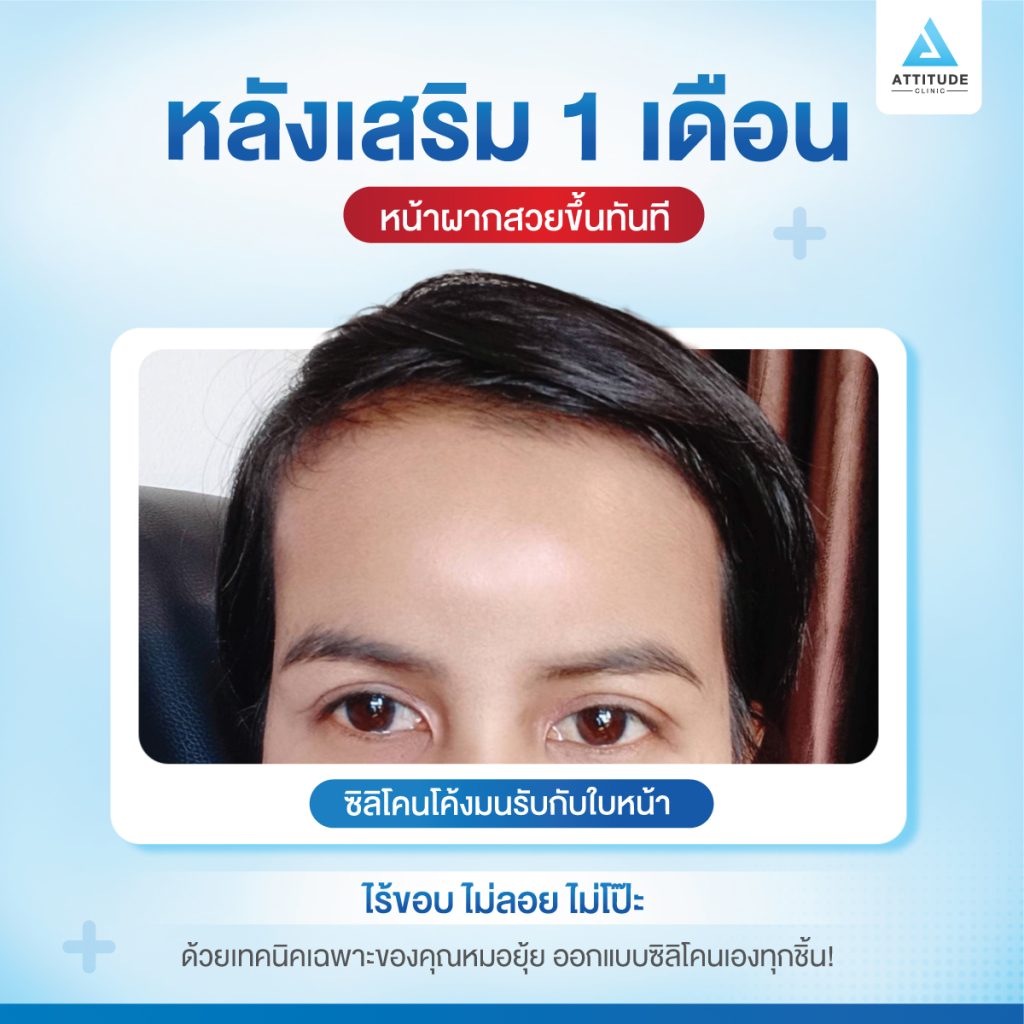 รีวิวประสบการณ์จริงจากคุณลูกค้า เกิดปัญหาซิลิโคนลอย เห็นขอบ มาแก้หน้าผาก S Curve ซิลิโคน Fitme เฉพาะบุคคล กับหมอยุ้ย Attitude Clinic รัชดา