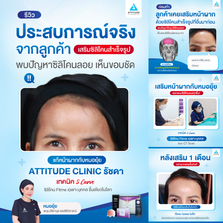 รีวิวประสบการณ์จริงจากคุณลูกค้า เกิดปัญหาซิลิโคนลอย เห็นขอบ มาแก้หน้าผาก S Curve ซิลิโคน Fitme เฉพาะบุคคล กับหมอยุ้ย Attitude Clinic รัชดา