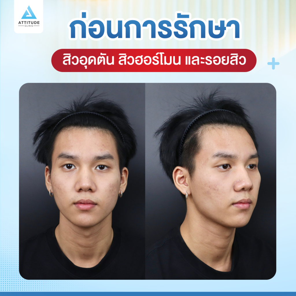 เคยเป็นสิวแต่ตอนนี้หายแล้ว เพราะมี Attitude Clinic เป็นตัวช่วยเรื่องผิวใส