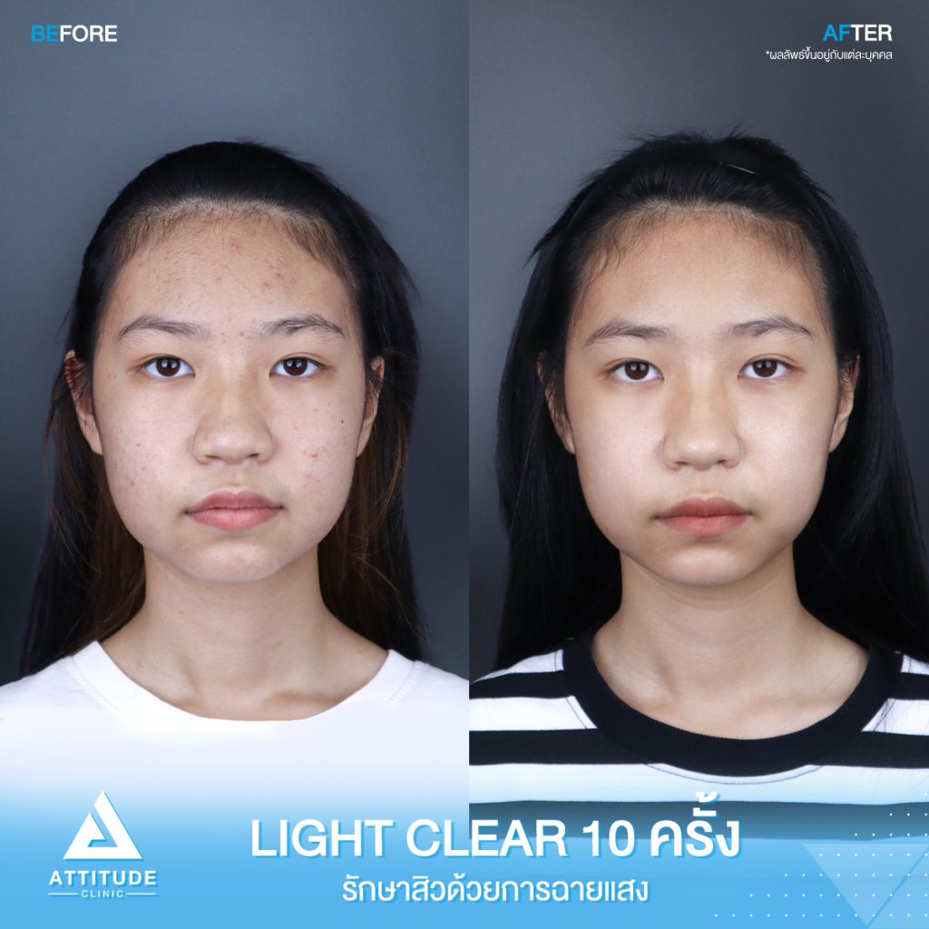 สิวเยอะแค่ไหนก็ไม่กลัว! รีวิวรักษาสิวด้วยการฉายแสงโปรแกรม Light Clear 7 ขั้นตอน จำนวน 10 ครั้ง ของน้องนิธิกานต์ มีปัญหาสิวและรอยสิวจัดเต็ม